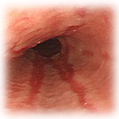 逆流性食道炎写真